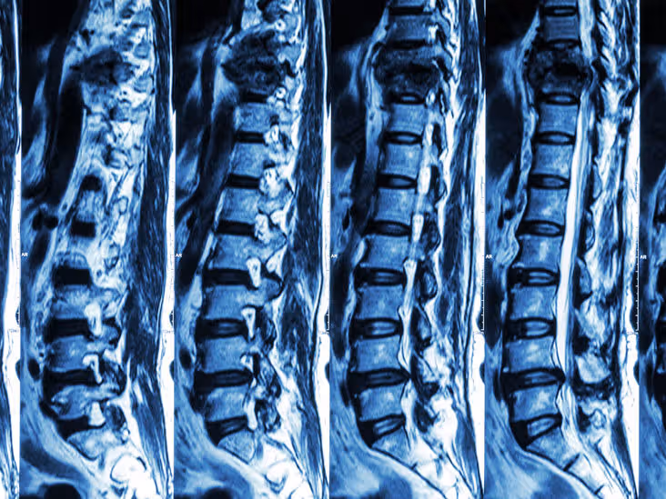 MRI Spine Scan